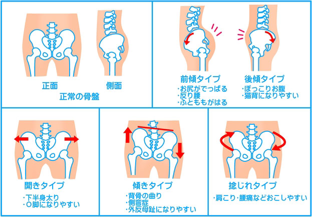 様々な骨盤の歪みのタイプ